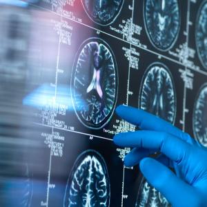 A hand in a medical glove touches a screen showing a patient's brain MRI (magnetic resonance imaging) scan.